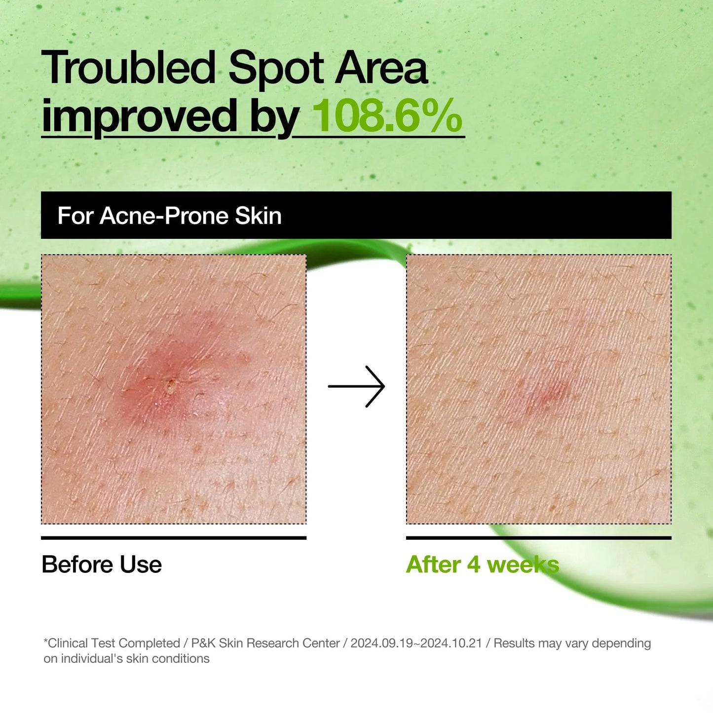 Sample ANUA Azelaic Acid 15 Intense Calming Serum